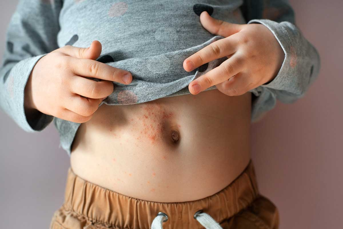 Scabies: Causes, Symptoms, and Effective Treatments