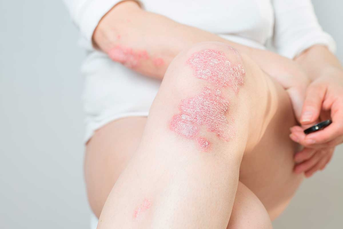 Understanding Psoriasis: Causes, Symptoms, and Treatments