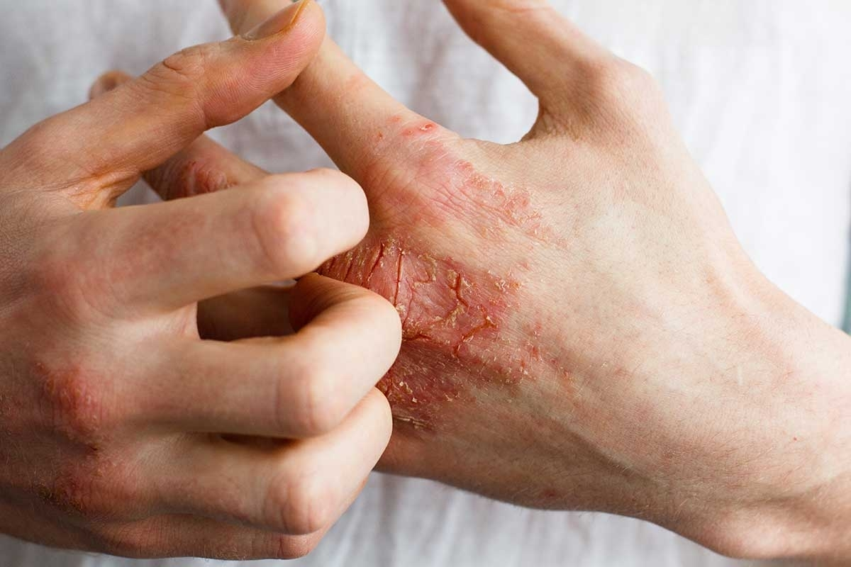 Dermatitis: Understanding Contact Dermatitis and Atopic Dermatitis