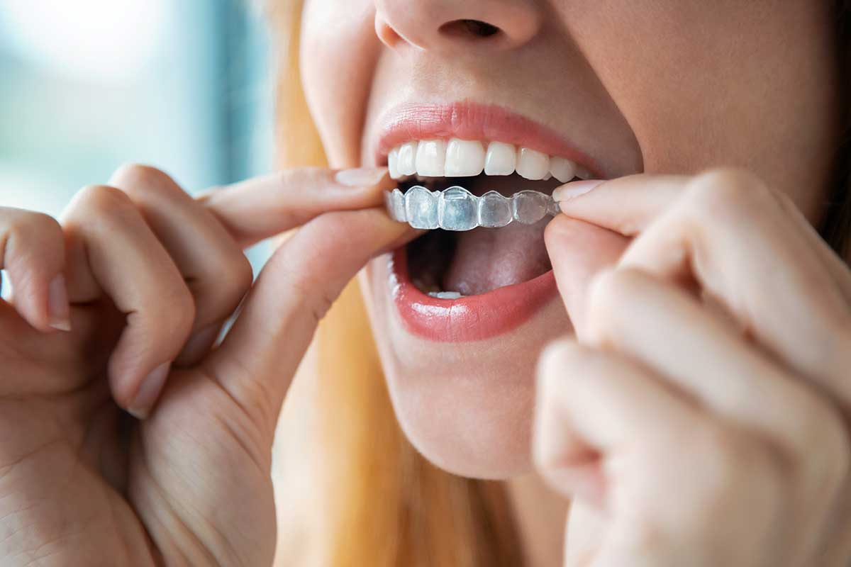 Invisalign in Bolingbrook / IL